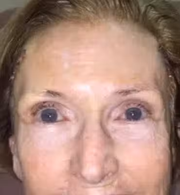 After Image: Brow Ptosis - front