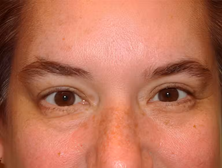 After Image: Upper Eyelid Blepharoplasty - front