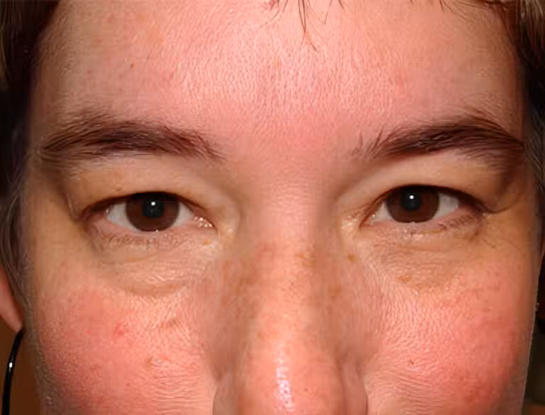 Before Image: Upper Eyelid Blepharoplasty - front