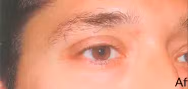 After Image: Transconjunctival Lower Eyelid Blepharoplasty - right-front-oblique