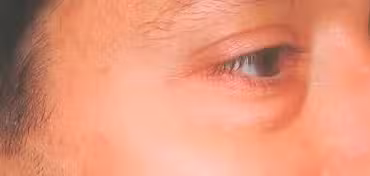 Before Image: Transconjunctival Lower Eyelid Blepharoplasty - right-front-oblique