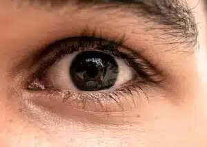 eyelid lift