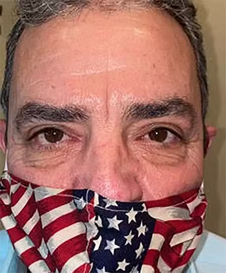 After Image: Upper Lid Blepharoplasty - front