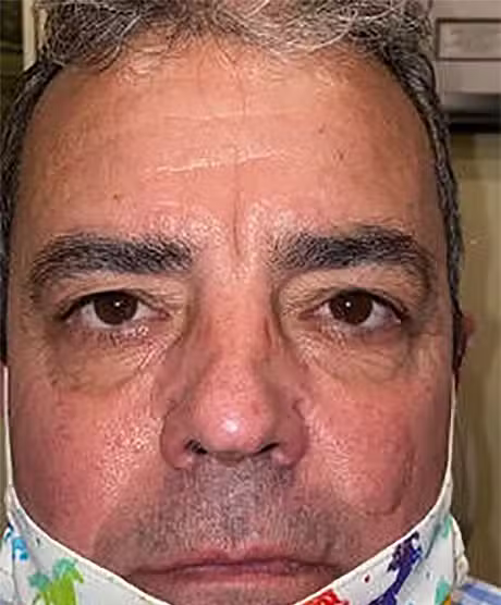 Before Image: Upper Lid Blepharoplasty - front
