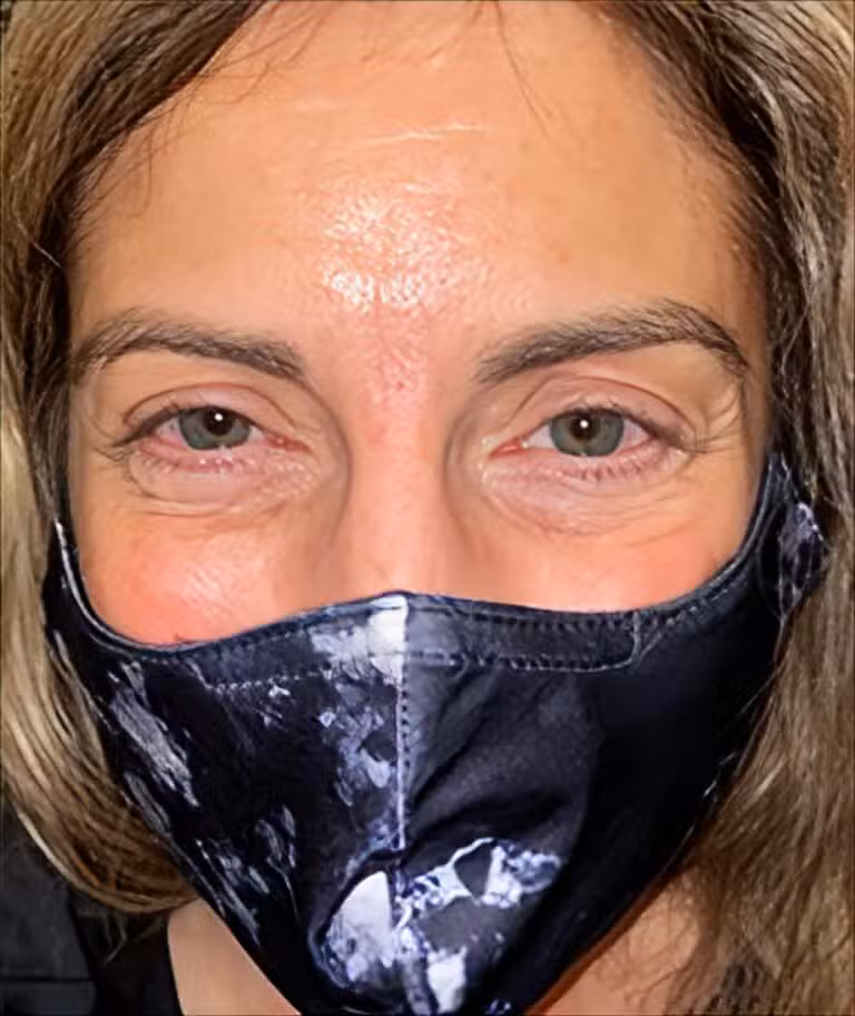 Before Image: Subciliary Lower Lid Blepharoplasty - front