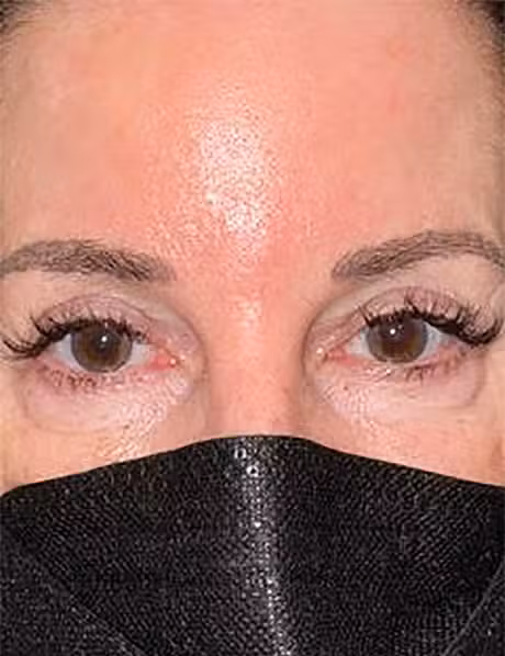 After Image: Lower Lid Blepharoplasty - front