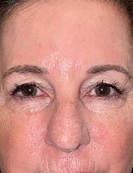 Before Image: Lower Lid Blepharoplasty - front