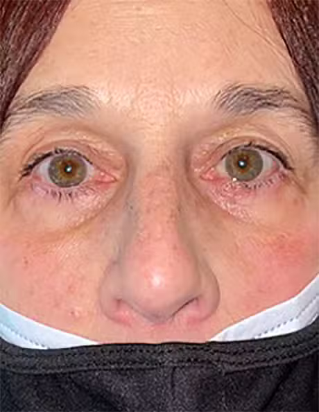 After Image: Transconjunctival Lower Lid Blepharoplasty - front