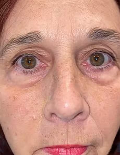 Before Image: Transconjunctival Lower Lid Blepharoplasty - front