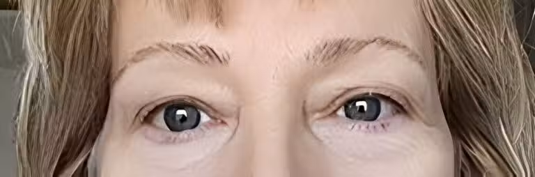 Before Image: Upper Lid Blepharoplasty - front