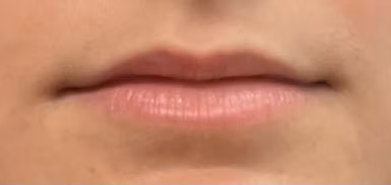 Before Image: Restylane Kysse - front