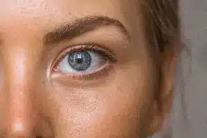 Brow Lift