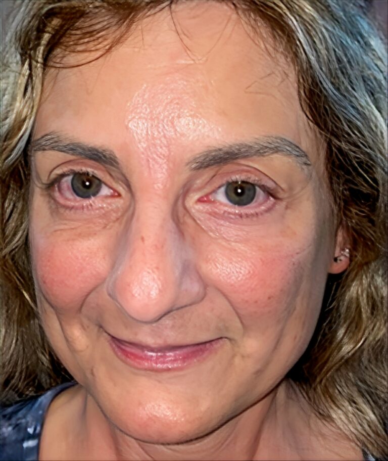 After Image: Subciliary Lower Lid Blepharoplasty - front