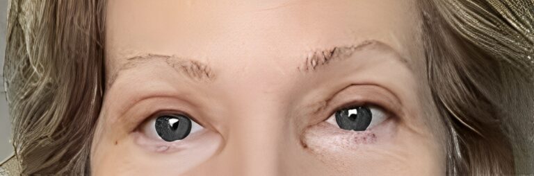 After Image: Upper Lid Blepharoplasty - front