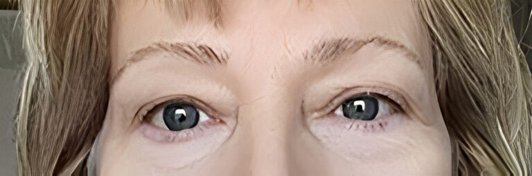 Before Image: Upper Lid Blepharoplasty - front