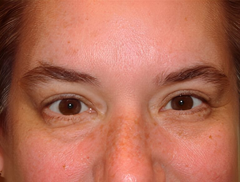 After Image: Upper Eyelid Blepharoplasty - front