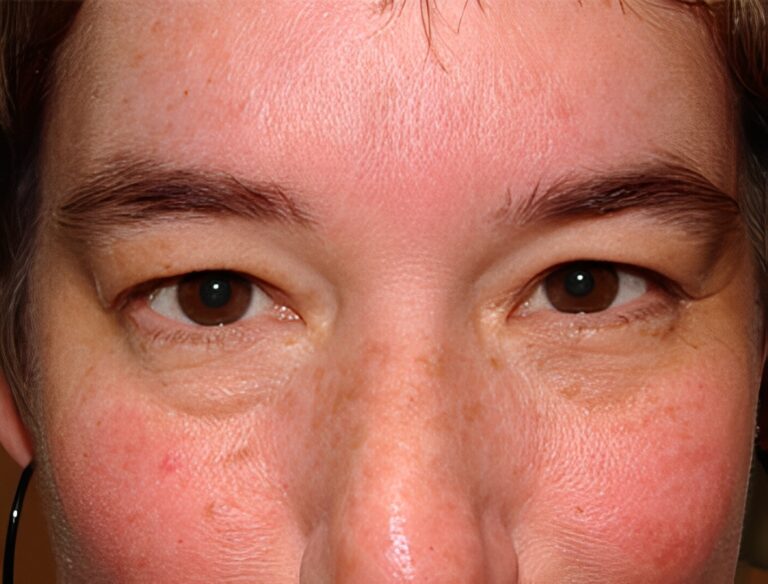 Before Image: Upper Eyelid Blepharoplasty - front