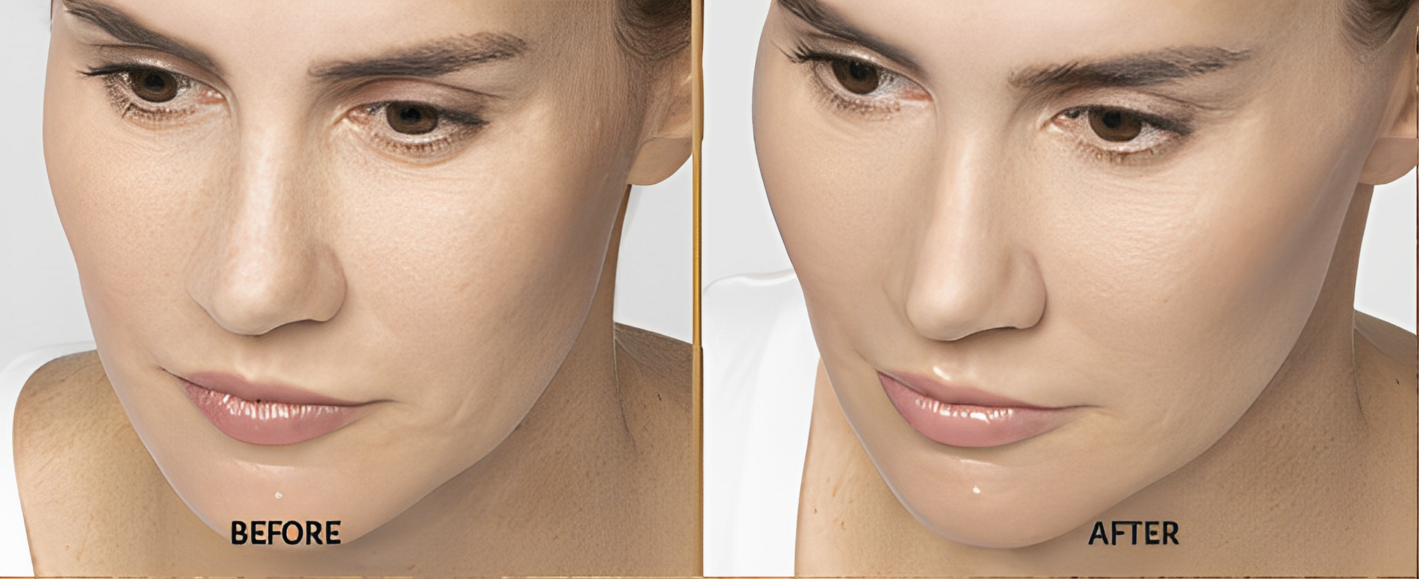 Restylane Lift 1(1)