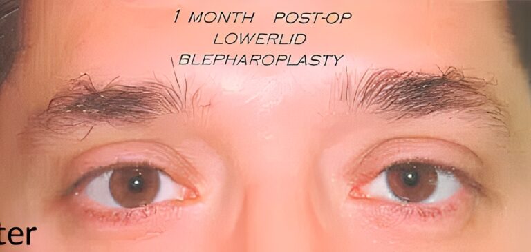 After Image: Transconjunctival Lower Eyelid Blepharoplasty - front