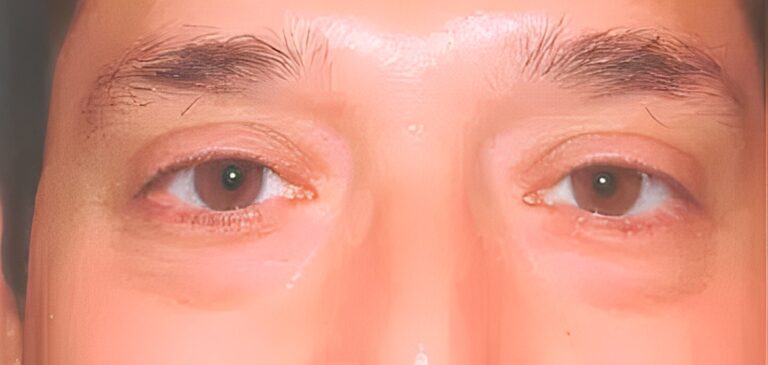 Before Image: Transconjunctival Lower Eyelid Blepharoplasty - front