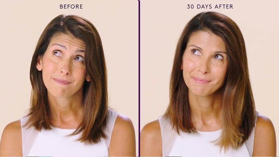 Before and after Botox treatment showing reduced frown lines.
