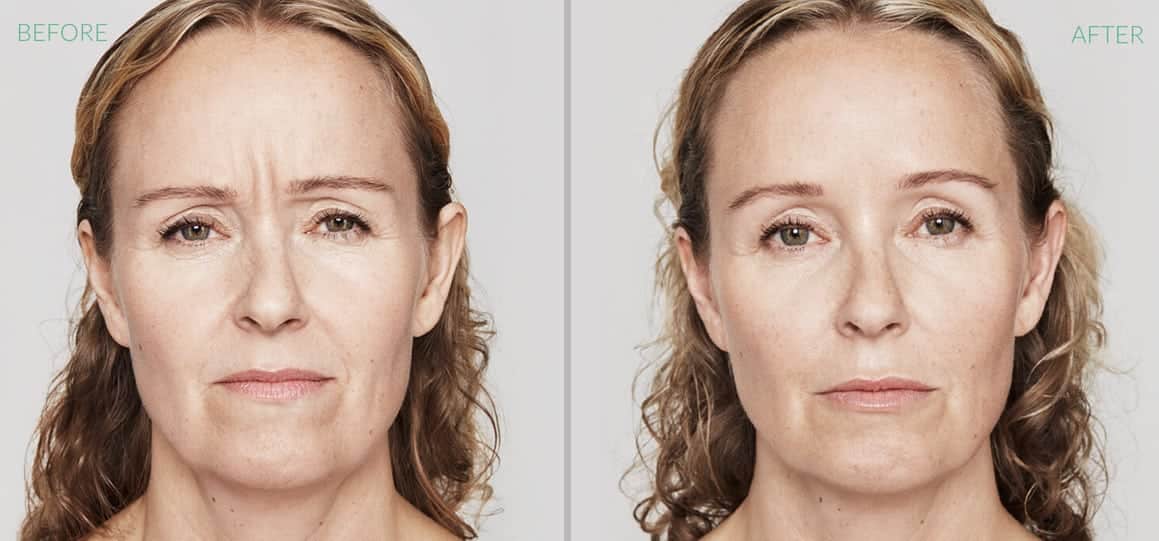 before after dysport