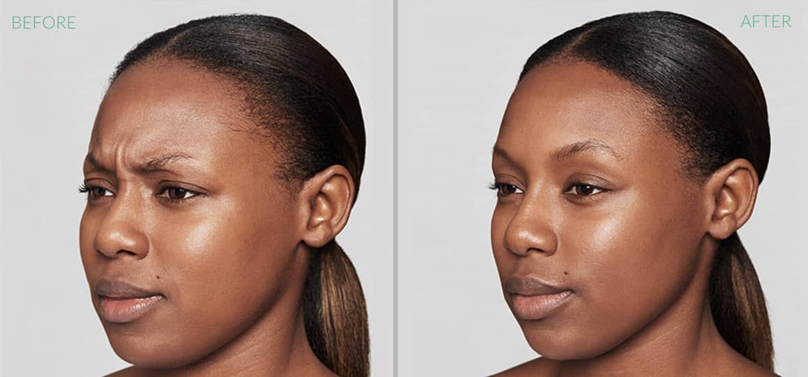 Before and after Dysport treatment for frown lines.