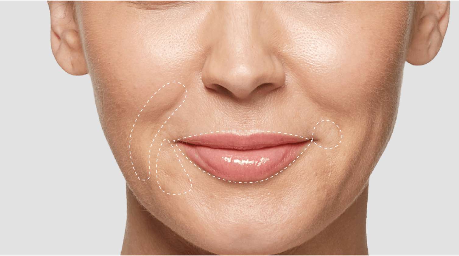 Dr. Rizzuto Restylane treatment focus on nasolabial folds.