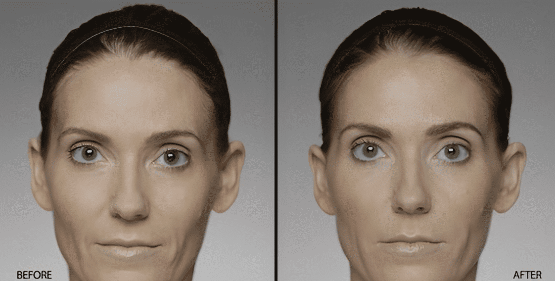 Before and after Restylane treatment by Dr. Rizzuto
