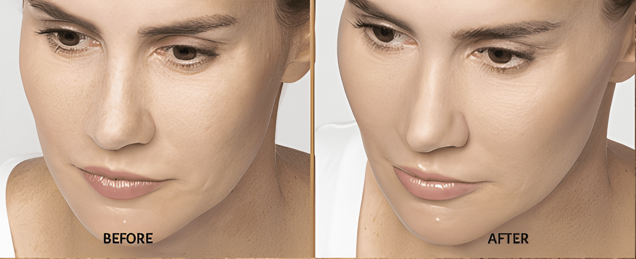 Before and after Restylane treatment by Dr. Rizzuto.