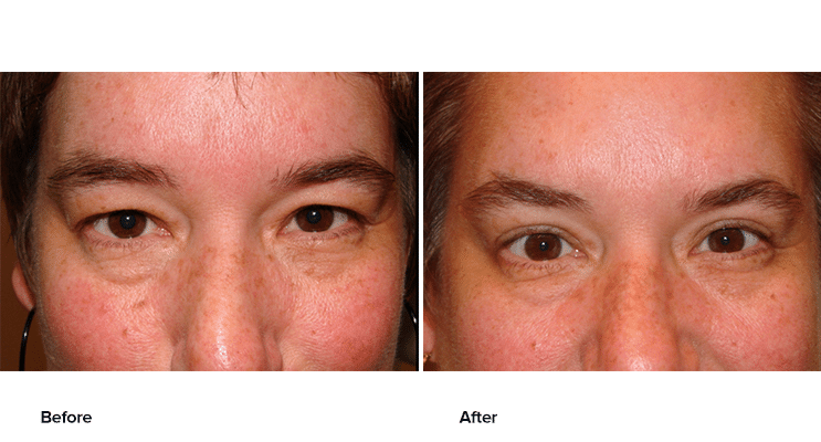 Before and after blepharoplasty at Rizzuto Eye and Face.