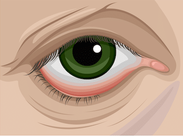 Illustration of an eye with droopy eyelid, related to ptosis.