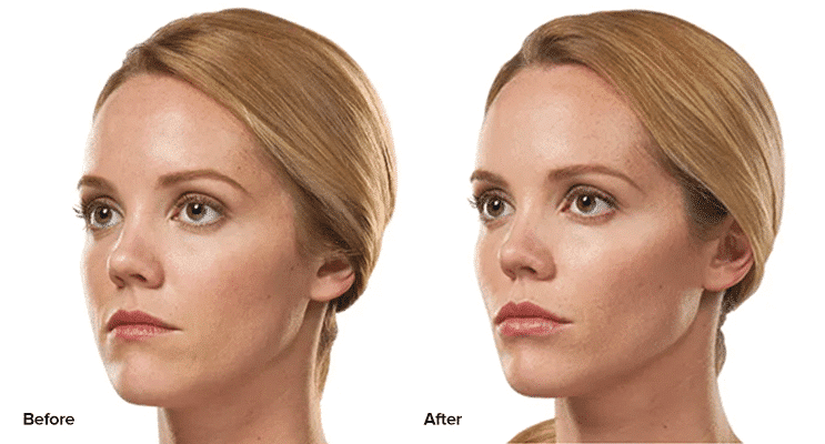 before and after Juvederm Voluma treatment Providence RI