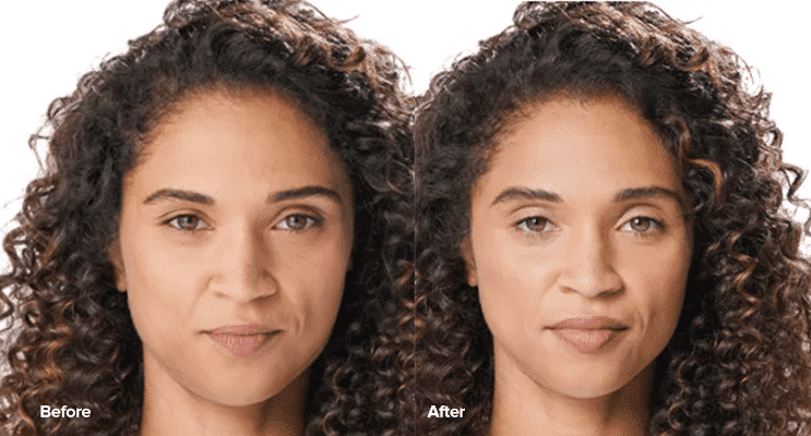 before and after Juvederm Volbella treatment Providence RI