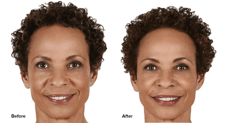 before and after Juvederm Vollure treatment Providence RI