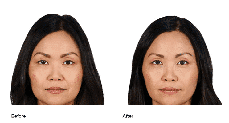 Before and after Juvederm treatment by Dr. Rizzuto