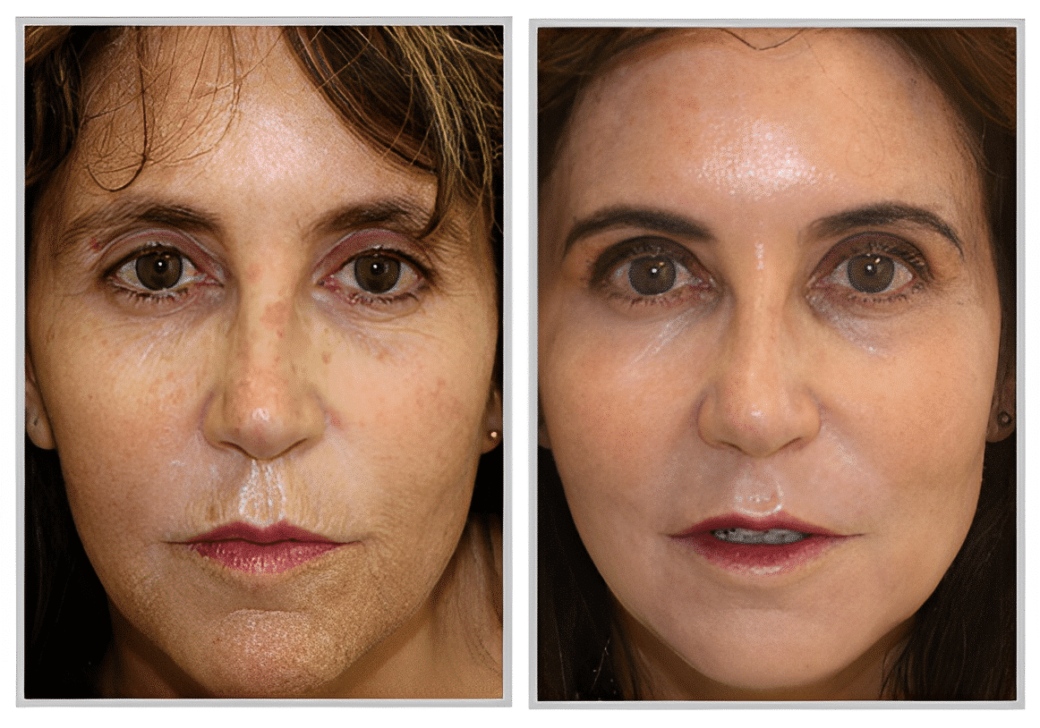 Before and after ProFractional Therapy by Dr. Rizzuto
