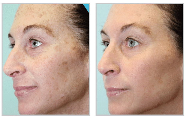 Before and after ProFractional Therapy by Dr. Rizzuto