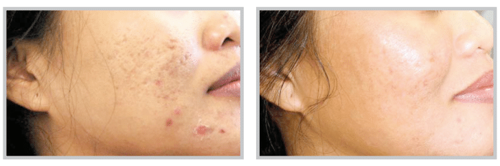 Before and after ProFractional Therapy by Dr. Rizzuto