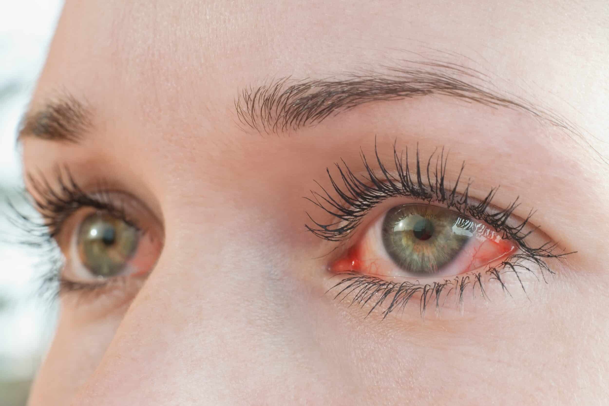 Thyroid Eye Disease Treatment Providence RI