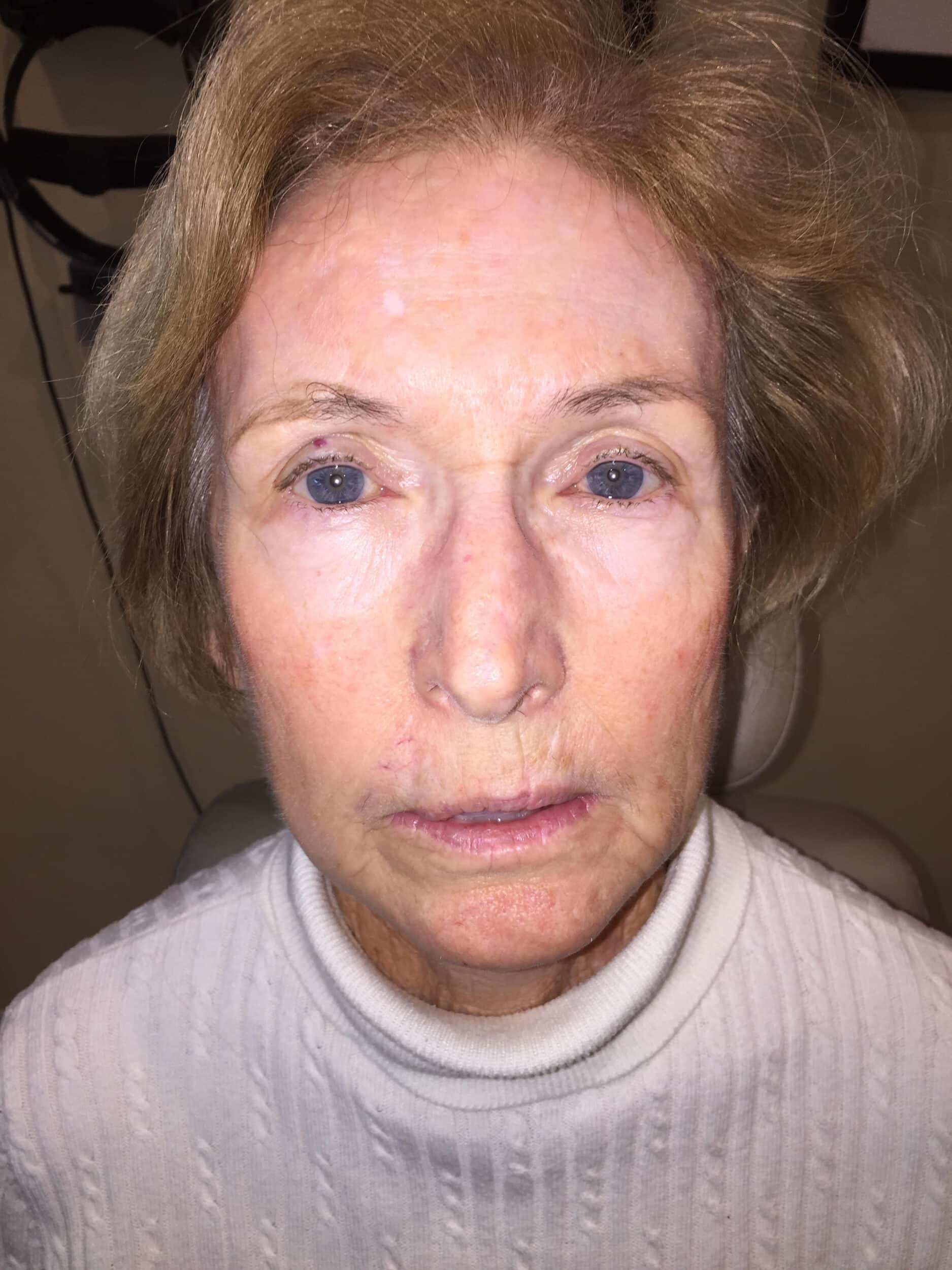 Patient before brow lift surgery by Dr. Rizzuto in Providence, RI